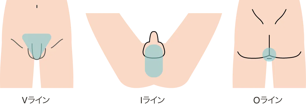 男性のVIO脱毛施術箇所のイラスト